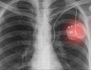 medical implant technology